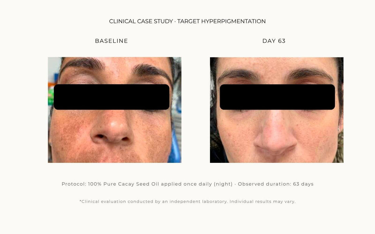 Smiling Skin Lab 100% Pure Cacay Seed Oil 63-day clinical results showing visible reduction in facial hyperpigmentation and sun damage